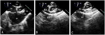 Simultaneous Percutaneous Interventional Treatment of Atrial Septal Defects and Pulmonary Valve Stenosis in Children Under the Guidance of Transoesophageal Echocardiography Alone: Preliminary Experiences
